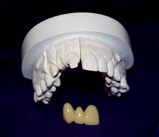 Dental Bridge